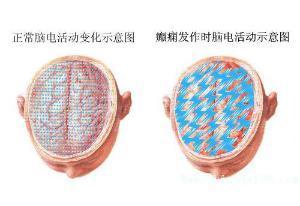 癫痫,是儿童时期最常见的一种良性部分性