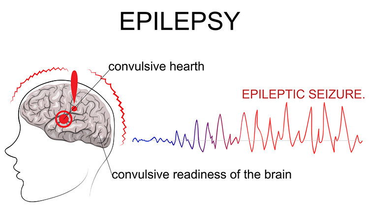 癫痫，一个做了就很难醒来的噩梦