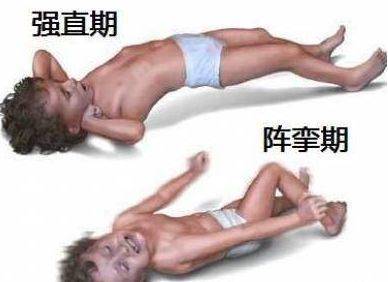 癫痫大发作的症状表现